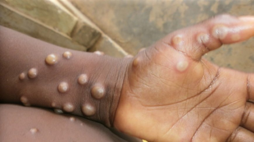 Five early signs of Mpox you should watch for